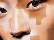 vitiligo: ¿manchas emocionales?