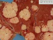 mayor proyecto para evaluar sabemos sobre cáncer primeros resultados buenos