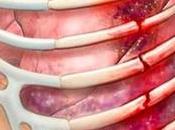Costilla fracturada: causas, síntomas tratamiento