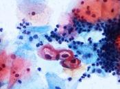 ¡Diagnosticado clamidia! ¿Qué sabes?