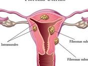 Tratamiento Quirurgico Fibromas Uterinos