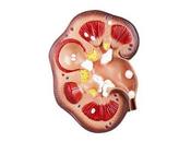 Piedras renales: ¿qué necesita saber?