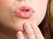 ¿Podrían problemas tiroideos causar labios rotos?