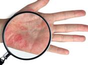 ¿Qué causa dermatitis mano?