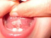 Dolor ampollas lengua