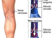 Consejos para prevenir varices