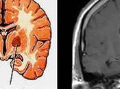 Mebendazol para Tratar Tumores Cerebrales