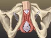 Complicaciones honda uretral