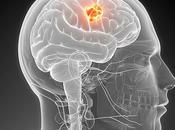 Estudian Nuevo Fármaco para Tratar Cáncer Cerebral