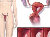 Cáncer endometrial uterino