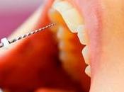 Endodoncia: cuándo realiza cuánto tiempo dura