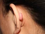 Tratamiento queloide cartílago oído perforado