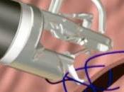 Método Apollo, técnica para personas obesidad quieren pueden pasar quirófano