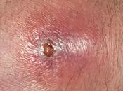 Antibiotico Usar Celulitis Complicada
