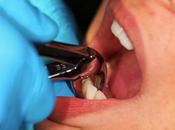 Extracción dientes después tratamiento cáncer: osteorradionecrosis otras complicaciones potenciales