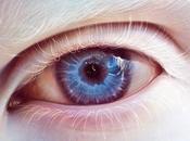 Síntomas tratamiento albinismo ocular