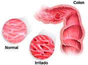 Colon irritable