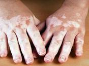 Novedoso Tratamiento para Vitiligo