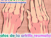 datos artritis reumatoide debes conocer