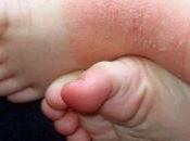 Dermatitis atopica bebes