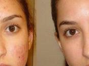 Como Eliminar Acne Rostro Rapido