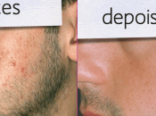 Como Eliminar Acne Rapido Paso