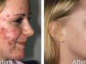 Como Contrarrestar Acne Remedios Naturales