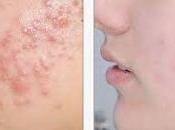 Como Quitar Acne Dela Cara Remedios Caseros?