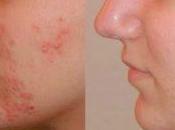 Tratamientos Para Acne Caseros Efectivos