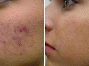 Mejor Tratamiento Natural Para Acne Severo