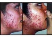 Remedios Naturales Para Acne Severo