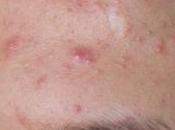 Tips Para Combatir Acne Nutrición