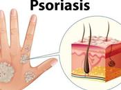 Psoriasis, ¿qué ¿como puede mejorar?
