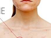 Como Quitar Acne Pecho?