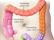 Cáncer colon: descubren nuevo para tratamiento