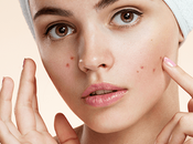 Remedio natural para acné espinillas