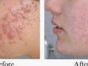 Como Eliminar Acne Para Siempre: Mejor Opción