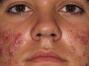 Como Desaparecer Acne Desde Interior