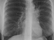 Porque Tuberculosis puede mantener latente