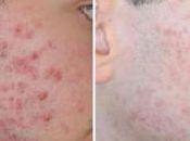 Como Quitar Acne Severo Rapido Casa