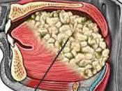 Síntomas cáncer boca