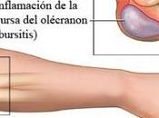 Bursitis