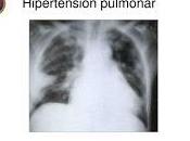 Nuevo Tratamiento para Hipertensión Arterial Pulmonar