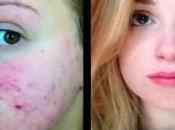 Como Eliminar Acne Quistico Cara