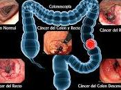 Bacterias Estrés Celular causan Cáncer Colon