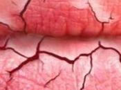 Remedios caseros para labios agrietados