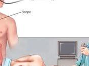 Consejos dietéticos para gastritis úlceras estomacales.