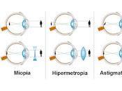miopía hipermetropía desarrollan diferentes vías moleculares