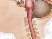 Cómo reconocer ictus (infarto cerebral)