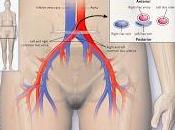 síndrome MayThurner